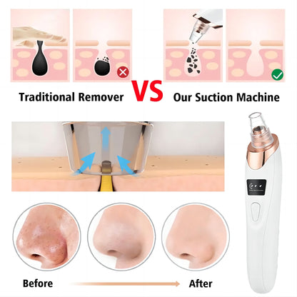SkinLune™ ClarityGlow Vacuum (Deep Pores Cleanser)
